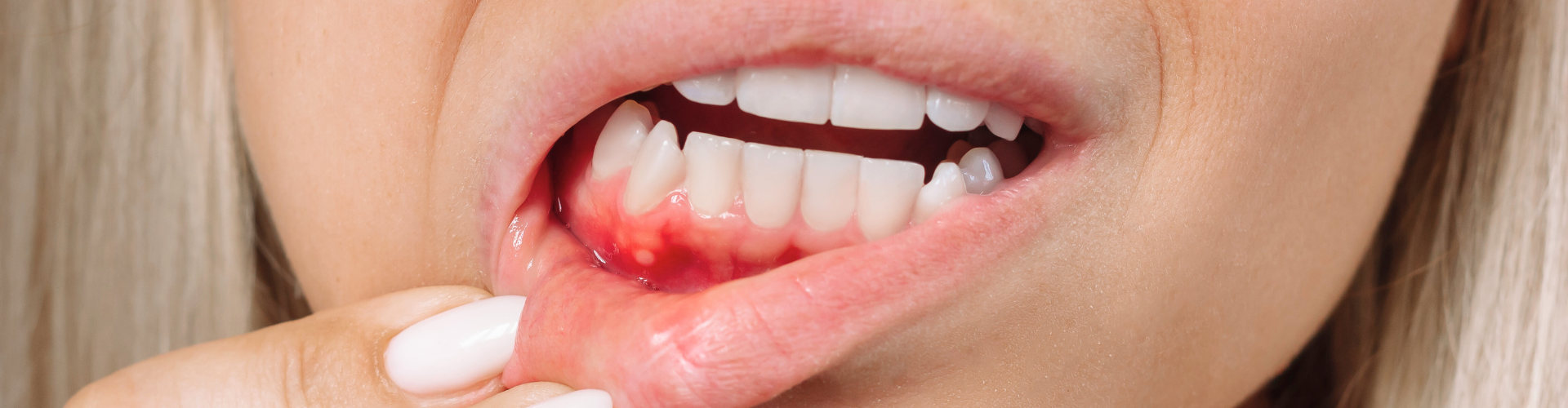 Woman pulling down lower lip to reveal inflamed gums.